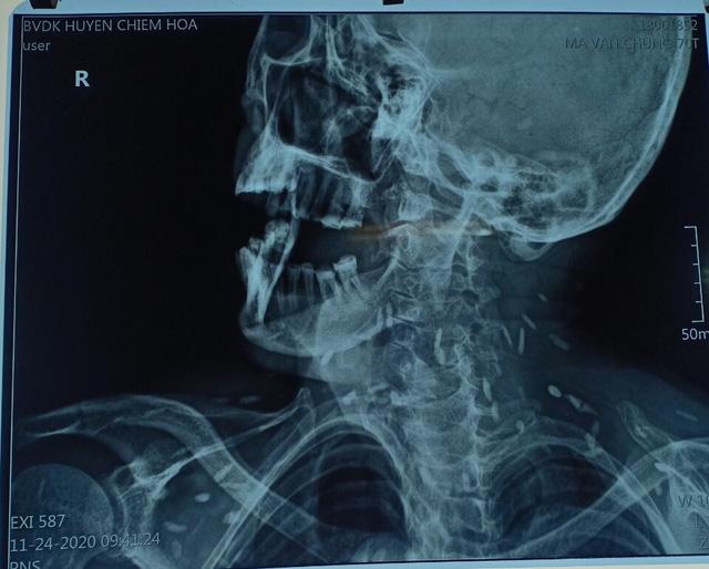 Tuyên Quang: Đi khám răng, cụ ông 70 tuổi rùng mình khi bác sĩ thông báo “chìa” hình ảnh sán lúc nhúc toàn thân - Ảnh 3.